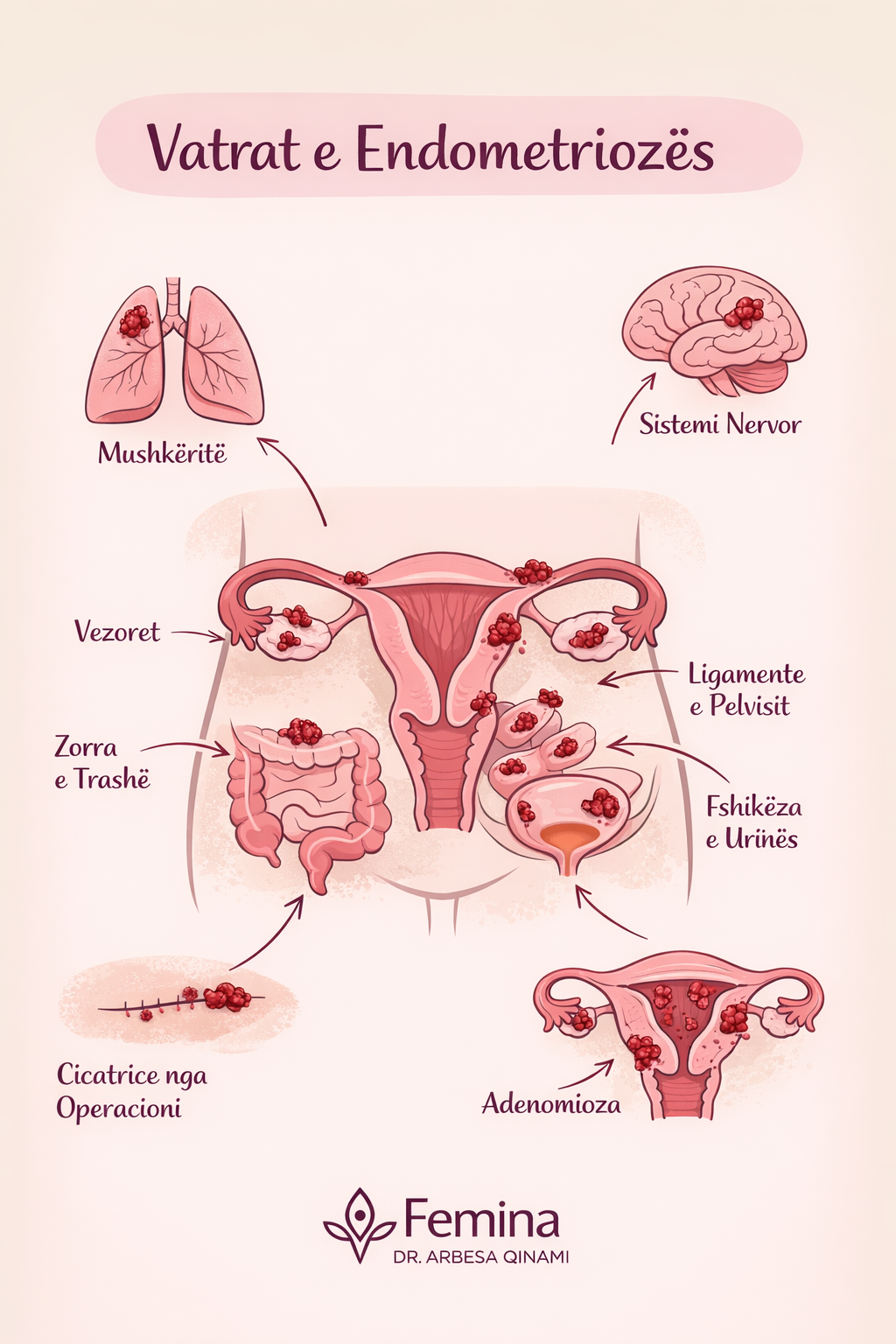 Ilustrim mjekësor i vatrave të endometriozës në vezore dhe legen