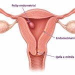 Ilustrim anatomik i mitrës me një polip endometrial brenda kavitetit.